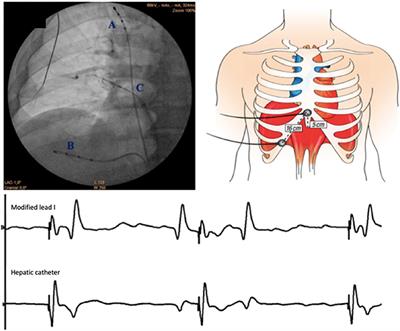 Diaphragmatic CMAP Monitoring During Cryoballoon Procedures: Surface vs. Hepatic Recording Comparison and Limitations of This Approach